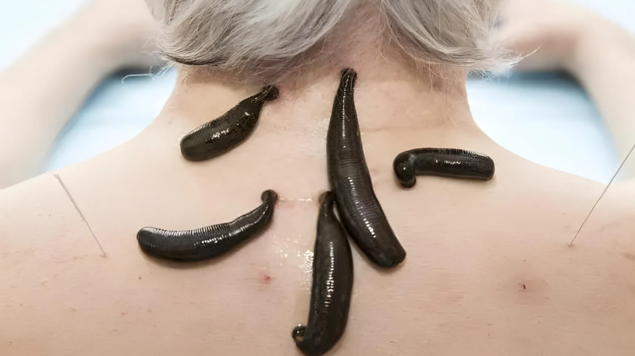 Benefits of Leech Therapy for Fibromyalgia Pain Management