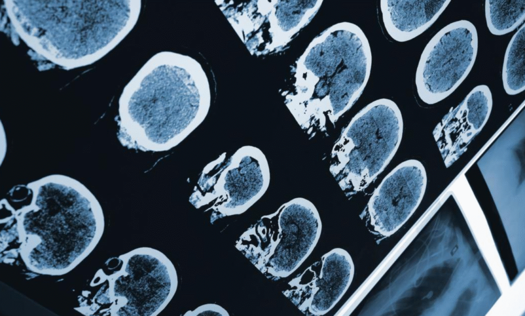 Fibromyalgia is Not All In Your Head, New Research Confirms