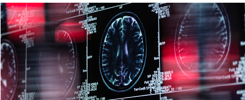Dementia Linked With Treatment For Chronic Lower Back Pain