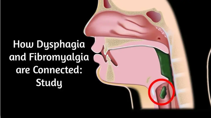 How Dysphagia and Fibromyalgia are Connected